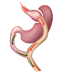 Roux-en-Y gastric bypass surgery diagram