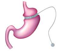 Gastric band surgery diagram